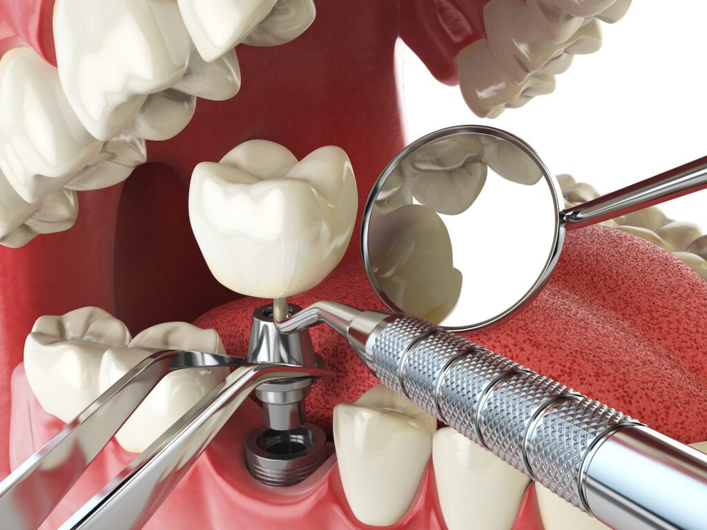 At Hillsborough Family Dental in Hillsborough, NC, we provide comprehensive care to aid in a successful dental implant process.