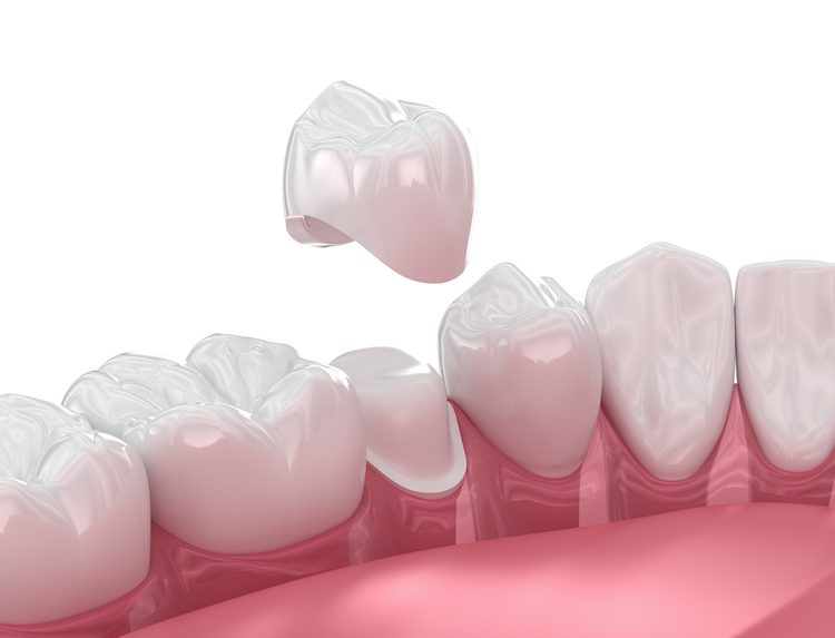 Dental crowns are often recommended by dentists for a variety of reasons. Understanding these helps patients make informed decisions.