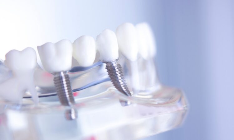 Understanding the factors affecting dental implant placement can help you make an informed decision about your oral health and smile.